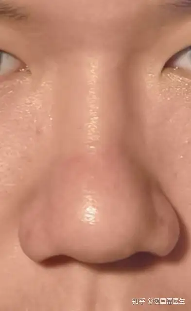 鼻头圆怎么缩小? - 知乎