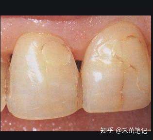 我大门牙有一道裂纹,我不会有事吧我牙不会掉吧,我好害怕? - 知乎