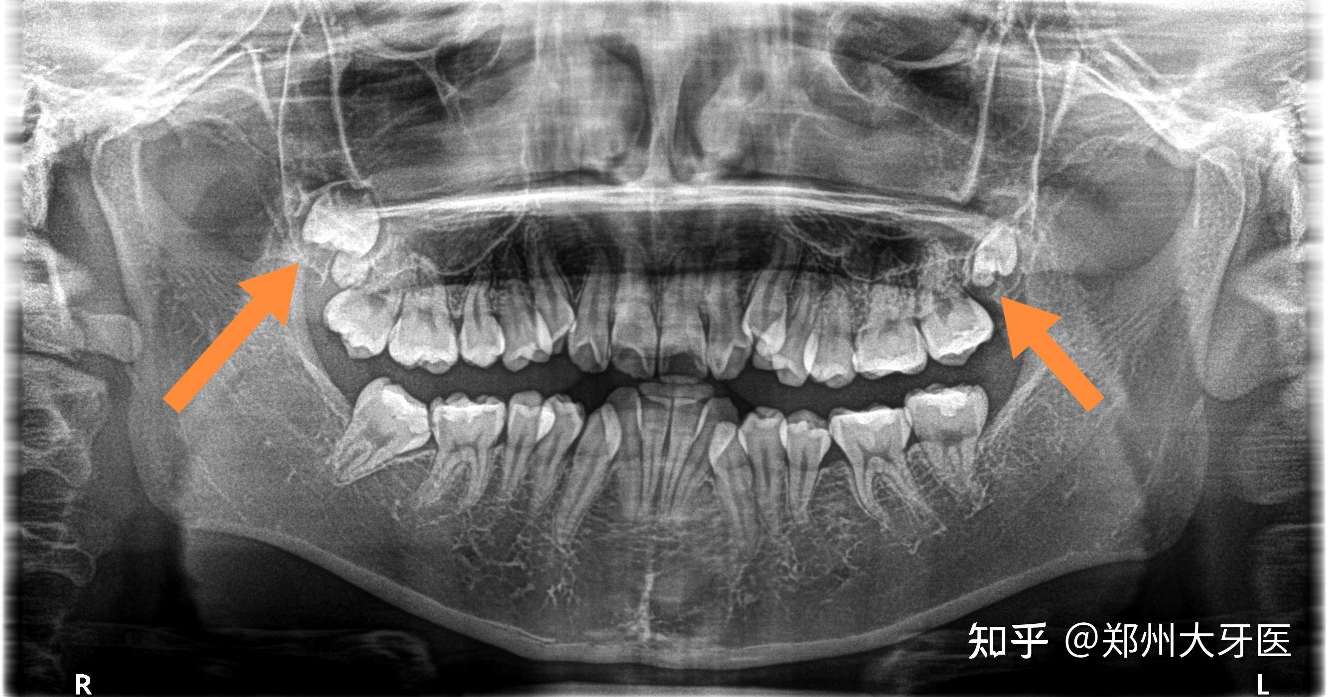 智齿长到上颌窦ct图图片