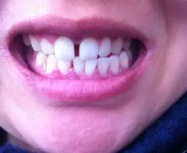 俩颗门牙长歪了所以门缝有点宽收缝的时候可以单独矫正门牙吗其他牙齿