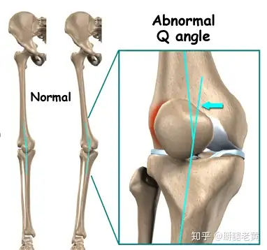 髌腱炎可以治好吗