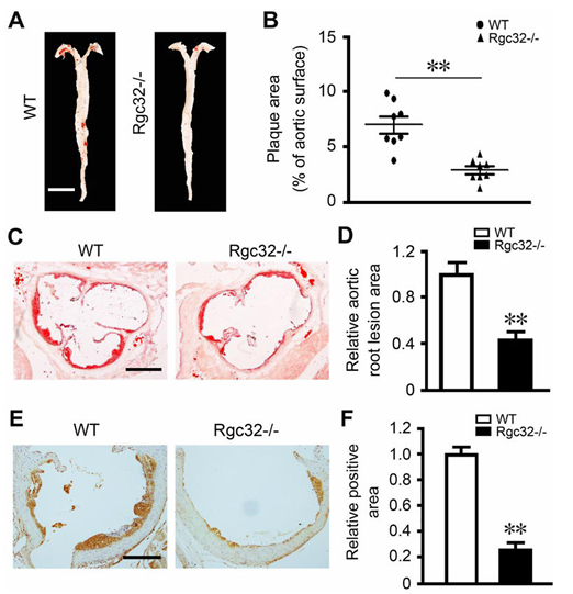RGC-32 缺失可保护内皮细胞免受炎症损伤并减轻动脉粥样硬化 RGC-32 缺失可保护内皮细胞免受炎症损伤并减轻动脉粥样硬化