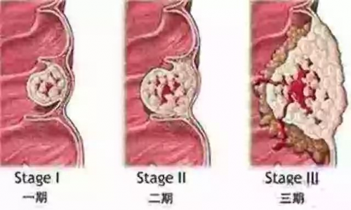 广州东大肛肠医院骗人吗大便带粘液是怎么回事呢？