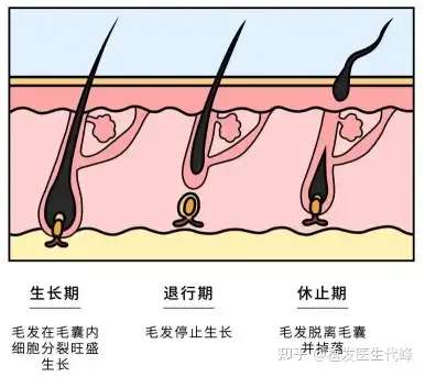 遗传性脱发基因究竟是遗传自爸爸还是妈妈?遗传性脱发有得治吗?