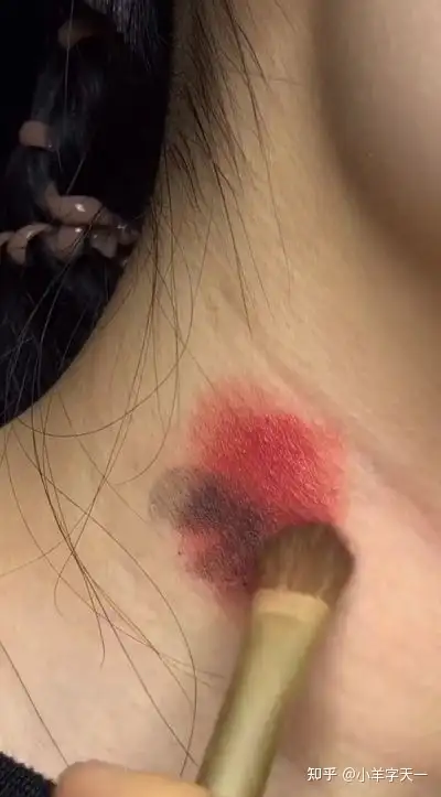 种在脖子上的草莓应该如何去掉? - 知乎