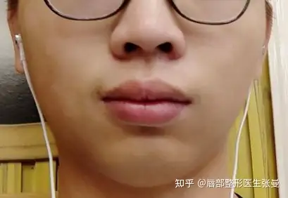 唇珠平了,怎么办? - 知乎