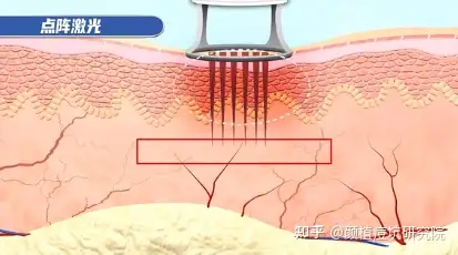 黄金射频微针和二氧化碳点阵激光,哪个祛痘坑效果好? - 知乎