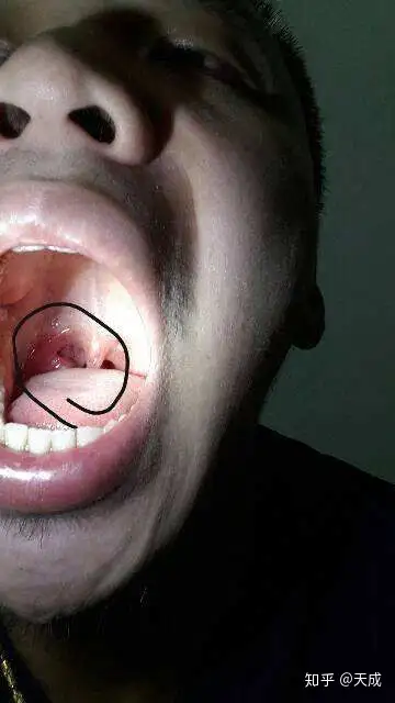 为什么会有人做出催吐这样的行为? - 知乎