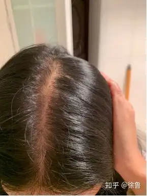 23岁女生狂脱发怎么能快速生发