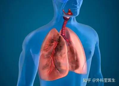 肺癌治愈的几率有多大?
