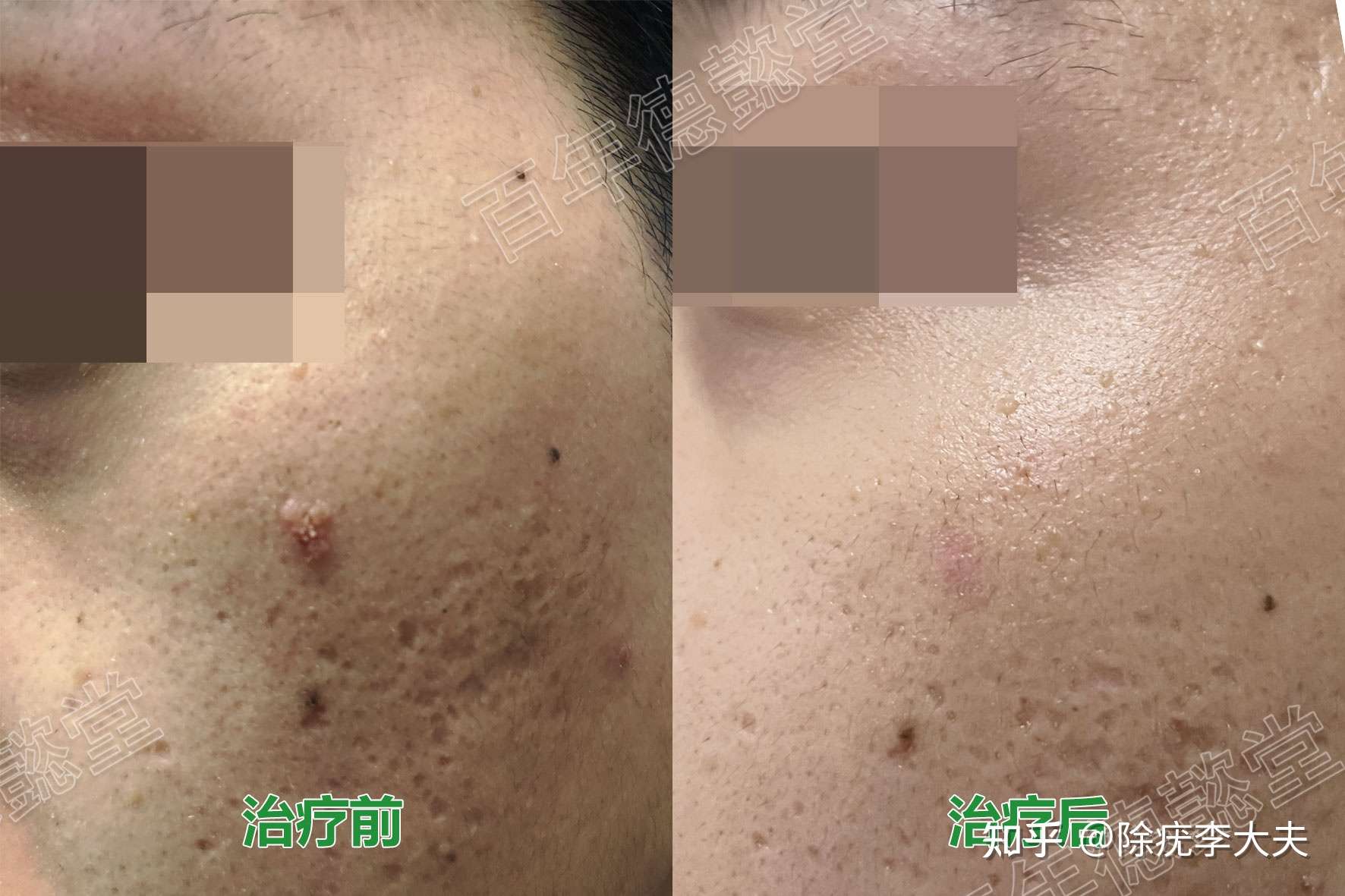 除疣李大夫 的想法: 呈散在或密集分布的浅褐色或棕黄色扁平丘