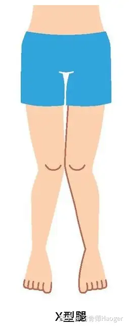 有同姐妹跟我一样的腿型吗然后矫正直了的吗跪求秘诀? - 知乎