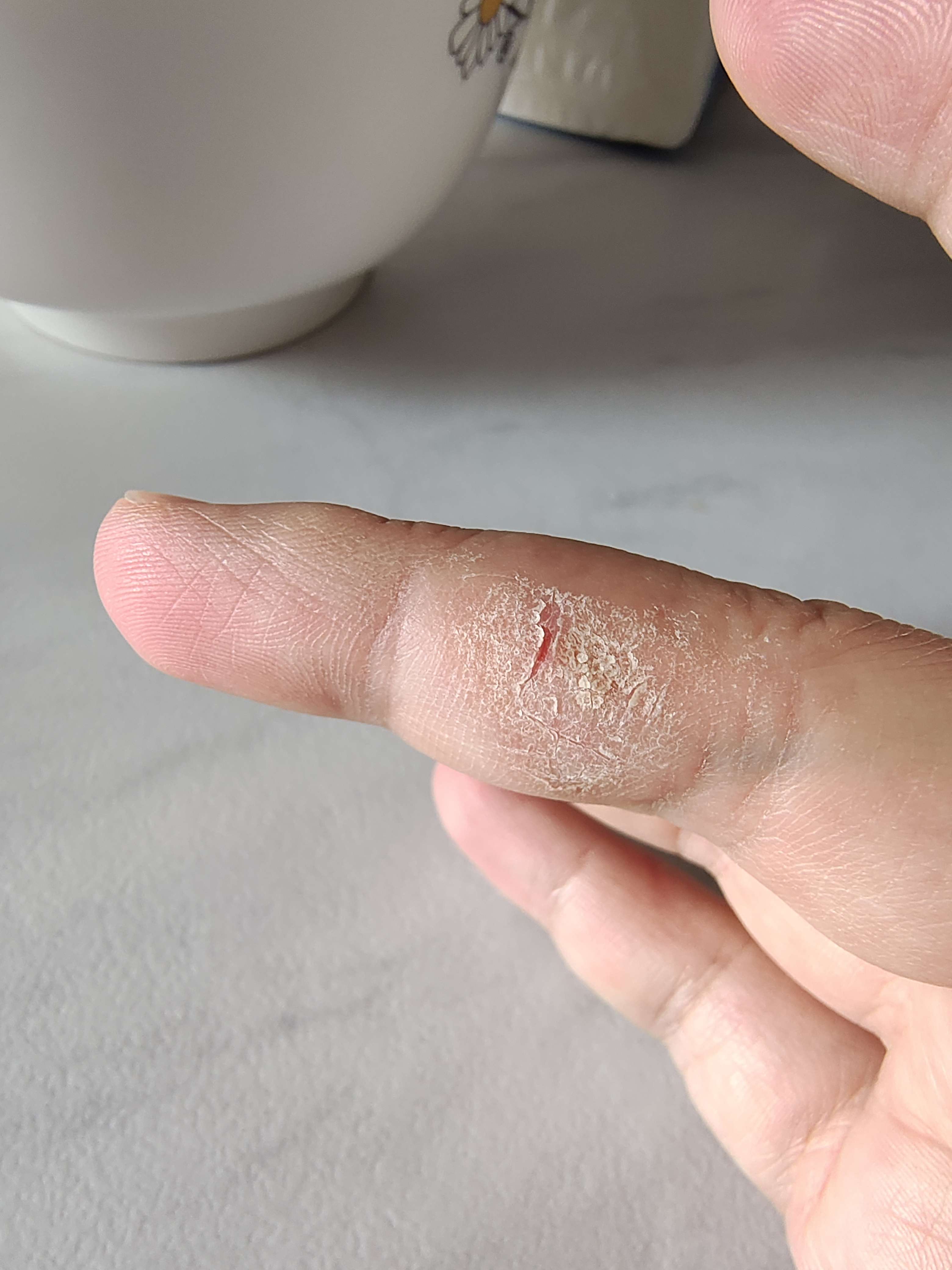 长命百岁 的想法: 家人们,手指头上的这种皮肤病怎么治? |