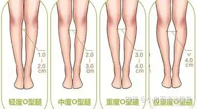 我这样的罗圈腿怎么矫正
