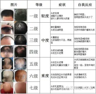 如何判断自己是否秃了还是大额头