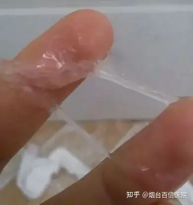 女生下面有白色豆腐渣是什麼原因