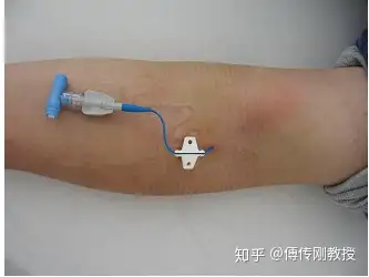 什么是picc置管? - 知乎