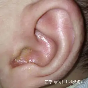 油耳朵的油是怎么来的? - 知乎