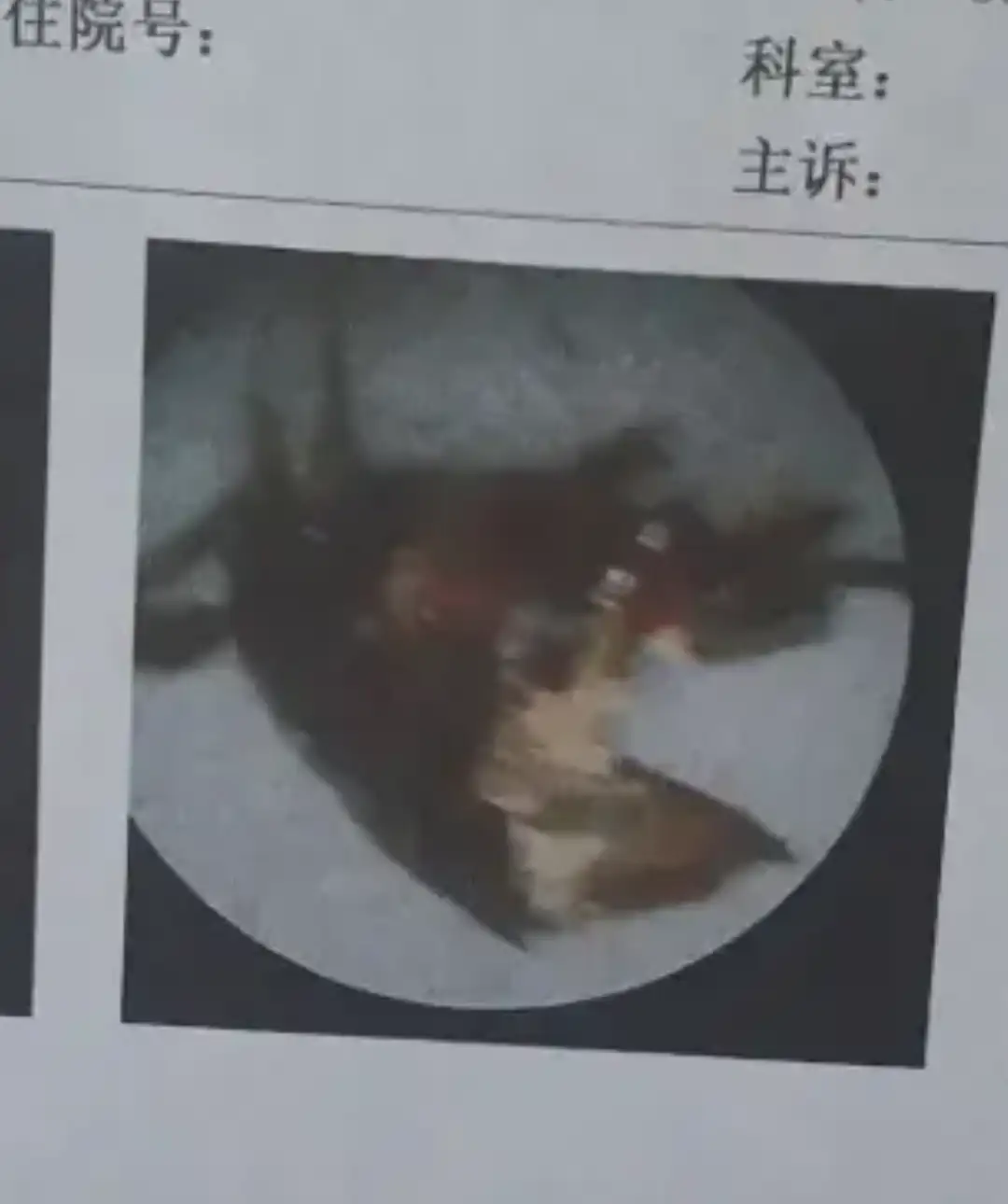 男子睡梦中蟑螂钻进耳道，拍打水冲后蟑螂死在里面，就医发现耳膜险穿孔，蟑螂等异物进入耳朵怎样处理最安全？