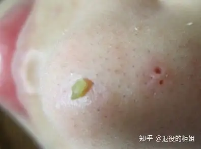 请问这个是黑头吗太可怕了