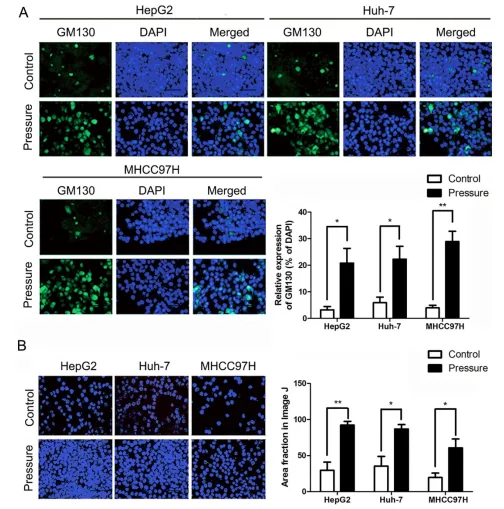 壓力響應(yīng)型 miRNA - 5703 的過(guò)表達(dá)抑制壓力誘導(dǎo)的肝癌生長(zhǎng)和轉(zhuǎn)移