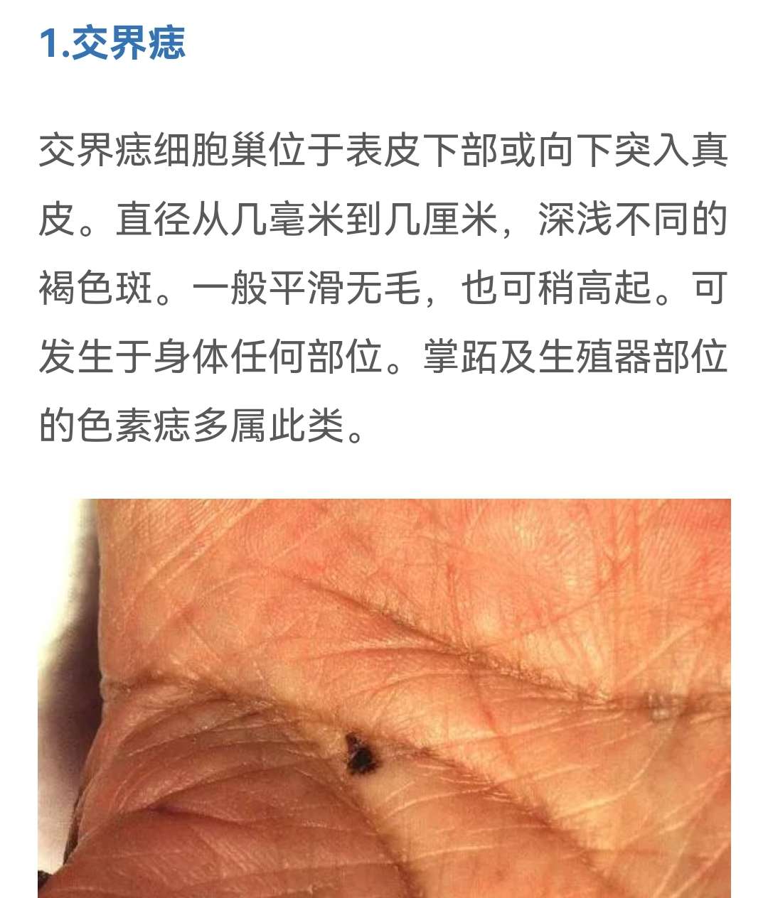卉卉圆 的想法: 痣的分类: 1交界痣 2混合痣 3皮内痣 - 知乎