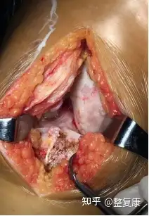 滑膜炎是什么样的? - 知乎