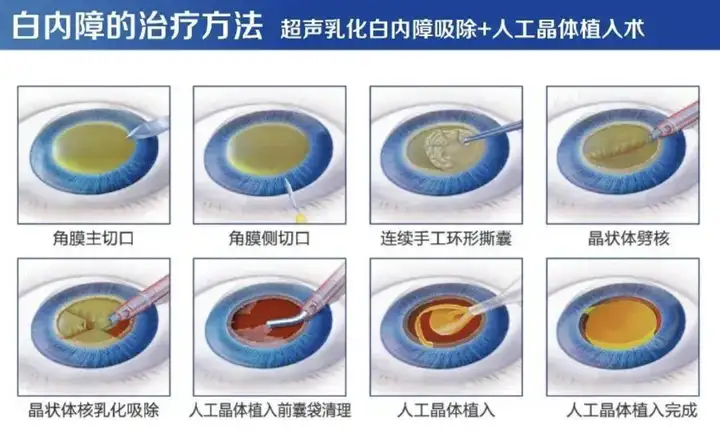 红谷滩普瑞眼科医院 【无惧时光·守护银龄】白内障手术如何选择人工晶体？