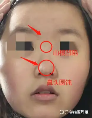 一点鼻梁都没有怎么办?