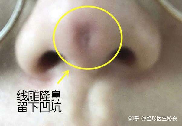 一些姑娘在做完线雕鼻后或是因为形态不好或是因为担心线体会从鼻尖穿