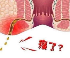 贵阳东大肛肠医院：肛瘘不做手术会怎样？用药能不能自愈？