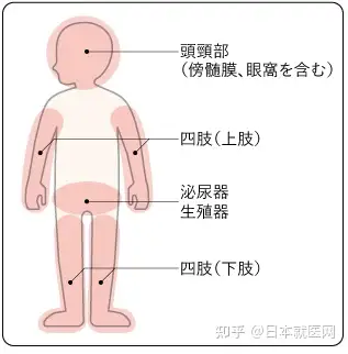 腹部横纹肌肉瘤图片