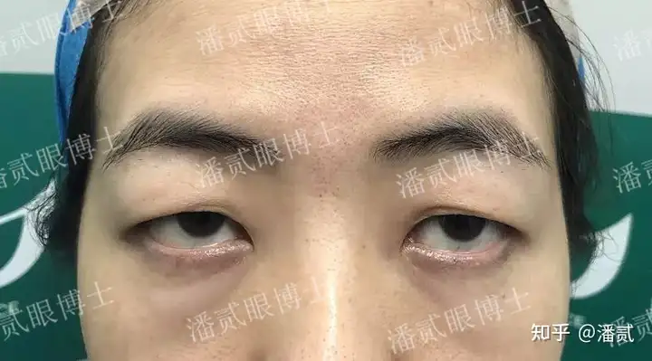 请问下三白眼如何改善呢? - 知乎