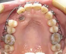 人的上颚有坑坑哇哇的褶皱是起什么作用的