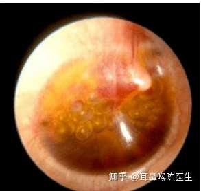中耳炎做了穿刺后感觉耳朵里有液体滚来滚去但是流不出感觉有什么堵住