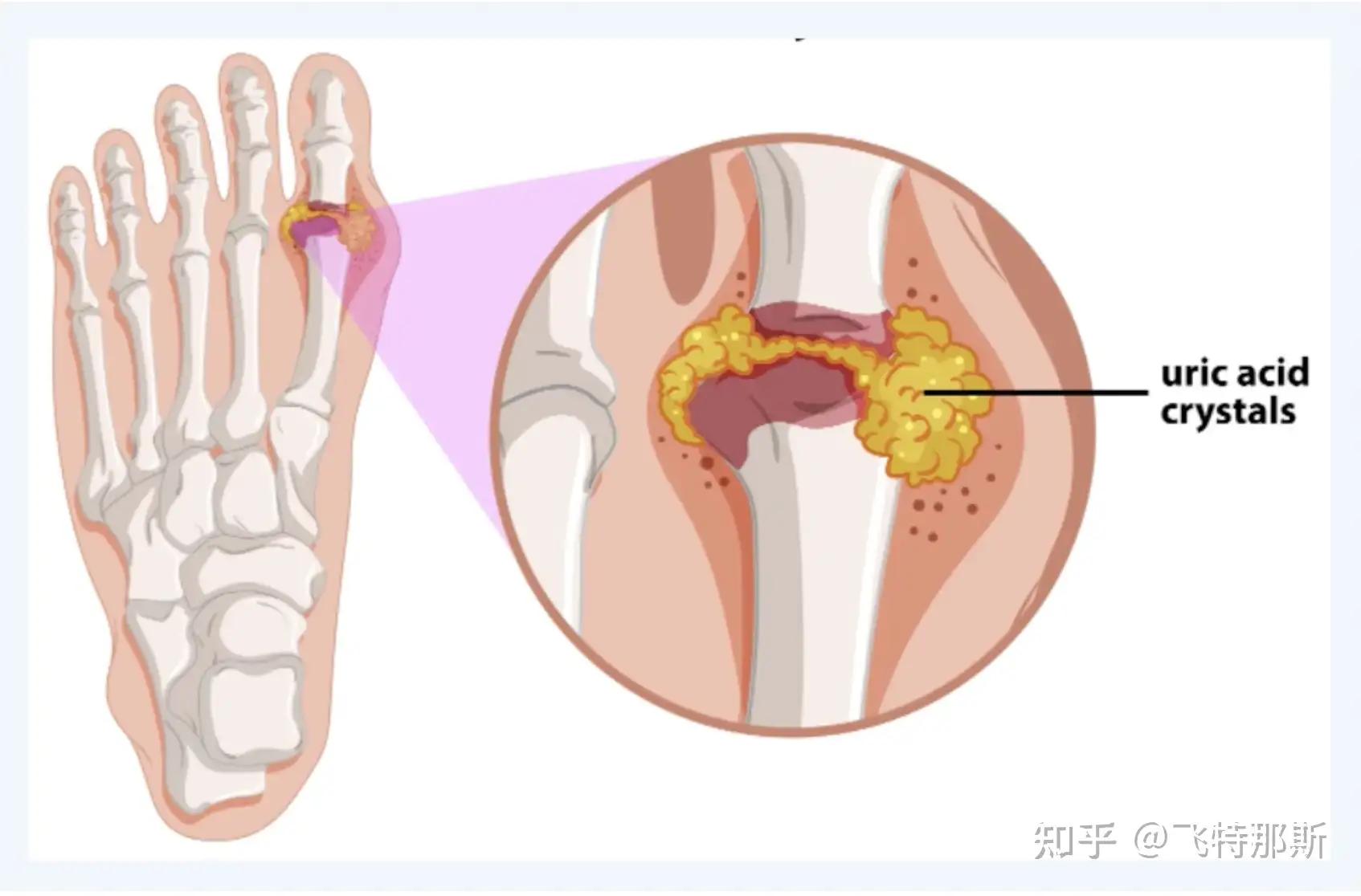 尿酸高该怎样降低？ - 知乎