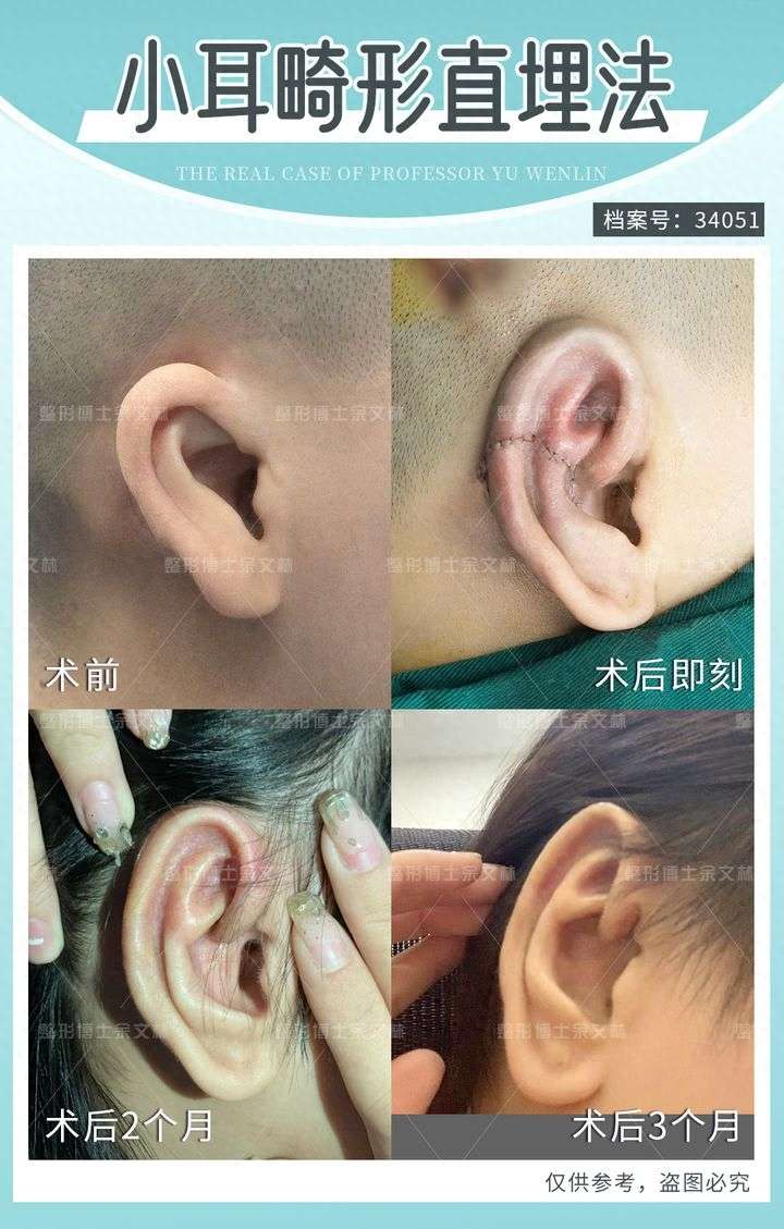 为什么余文林博士做耳再造尽量不植皮?