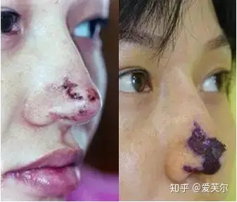 有什么风险比较小的整容么