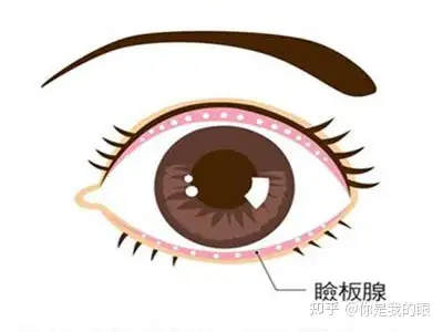 睑板腺一旦堵塞，想要疏通是不是非常难？ - 知乎