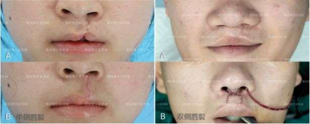 唇裂孩子为什么鼻子也塌了?专家提醒这个年龄快去修复!