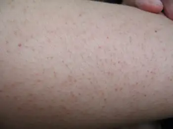 毛周角化症鸡皮肤本质上究竟是什么导致的能改善吗