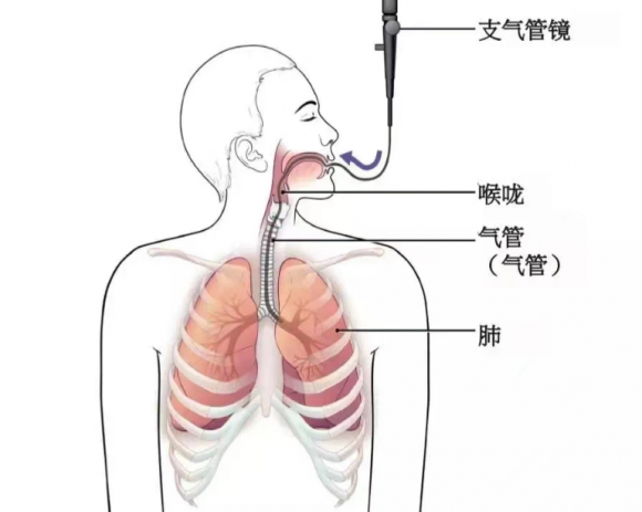 成都中医哮喘医院“纤”入为主，一探究“镜”：揭开智能超导可视介入技术的神秘面纱