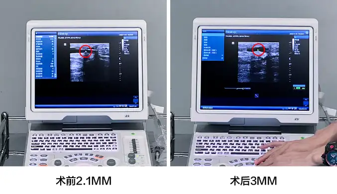 打通“生命线”｜我院成功开展“介入无植入”——血管球囊扩张术！