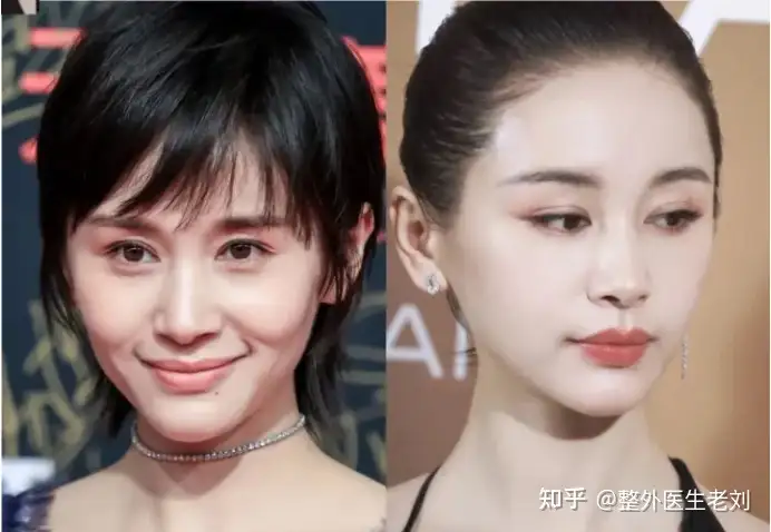 改善面中凹陷的方法有哪些? - 知乎