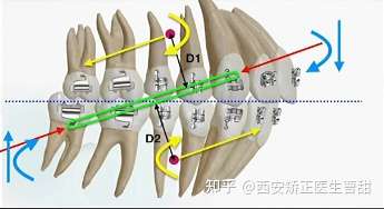 正畸二類牽引會把下巴給牽沒了嗎