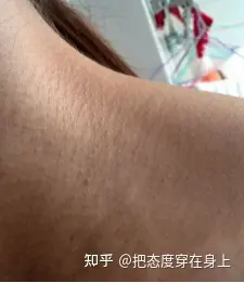 脖子鸡皮肤怎么解决? 