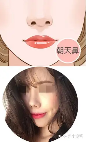 朝天鼻怎么办?