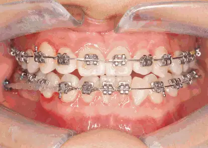 凸嘴凸成这样该怎么办?