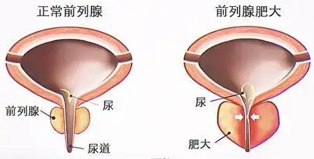 阐老艳帅腺“蔓了”，畜要滴剂致3个儒孽，控衰炕榨而肾(图2)