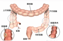 贵阳东大肛肠医院：长了结肠息肉要不要切？切了会不会复发？